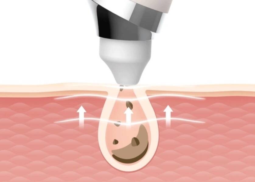 Аппарат для чистки лица Xiaomi GOODtime Pick Up Visual Blackhead Remover Pink (Розовый)